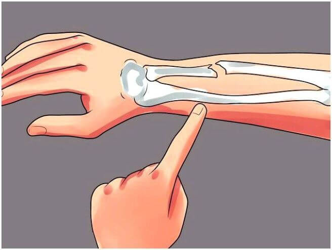 Почему немеют пальцы рук после перелома лучевой кости